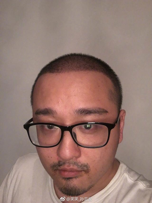 尊龙人生就是博LOL笑笑展现植发成果网友